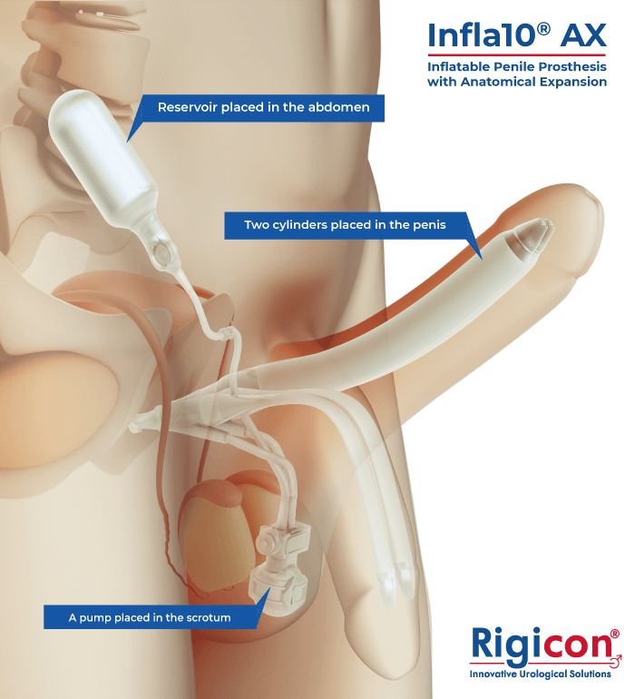 Infla10 AX Inflatable Penile Prosthesis with Anatomical Expansion