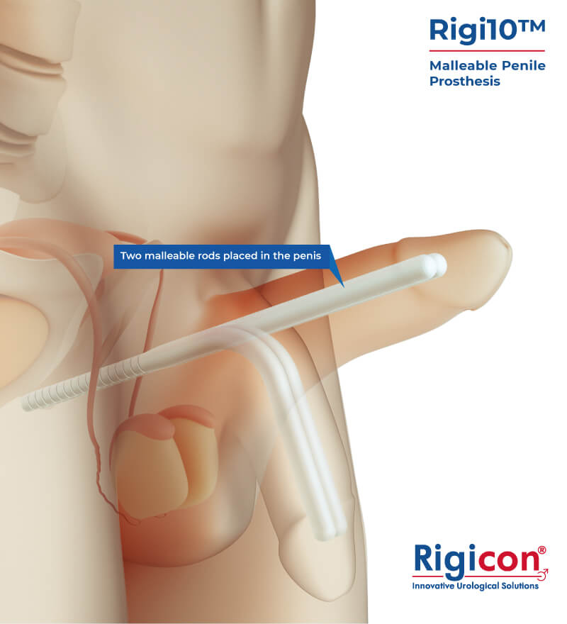Rigi10&trade; Malleable Penile Prosthesis